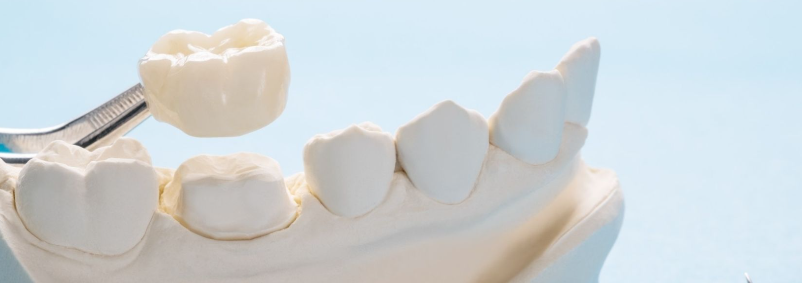 Porcelain dental crown held above a model of teeth before fitting