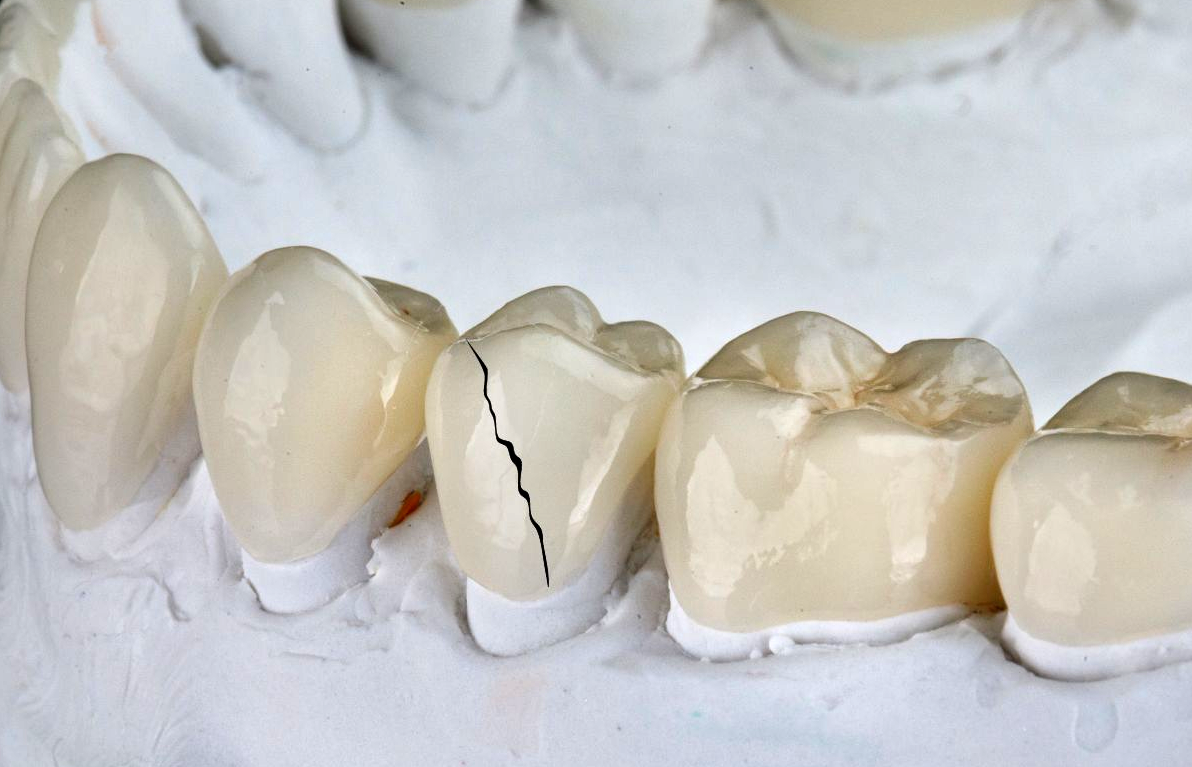 Broken dental crown showing a chipped tooth restoration