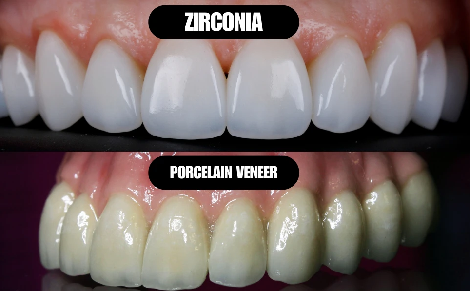 Porcelain and zirconia dental crown samples showing natural tooth color matching
