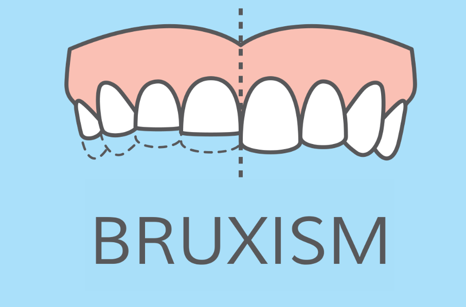 Illustration of teeth grinding and jaw clenching caused by bruxism