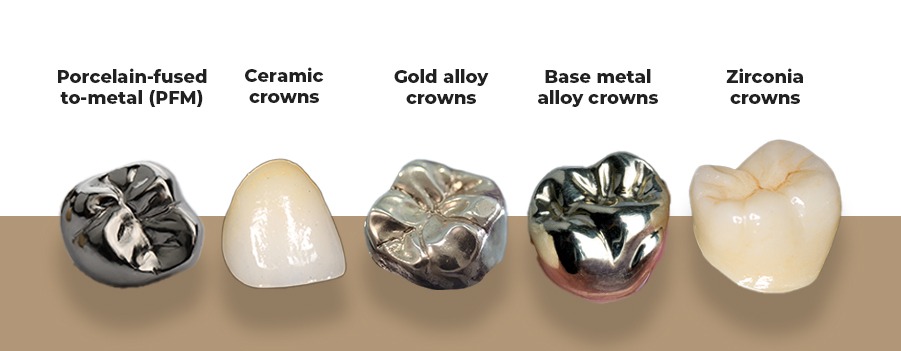 Dental crown restoration on a tooth