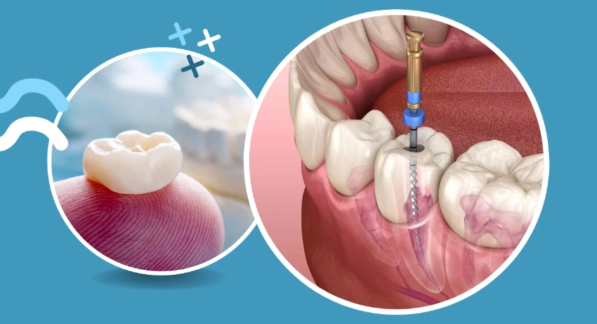 Diagram of root canal treatment showing the infected tooth pulp being removed